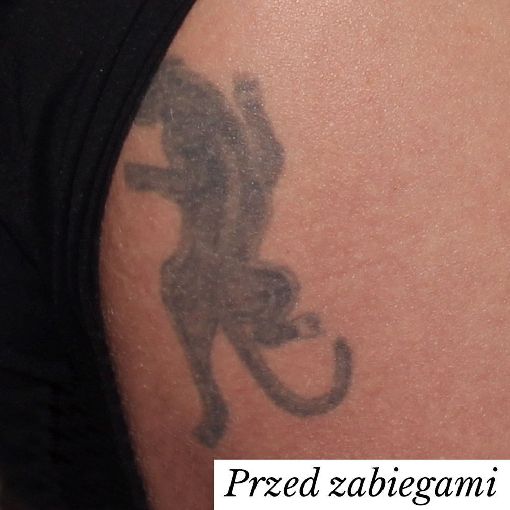 usuwanie tatuażu laserem pikosekundowym